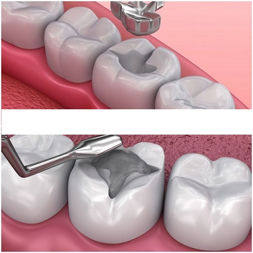 Dental Fillings in Harare 